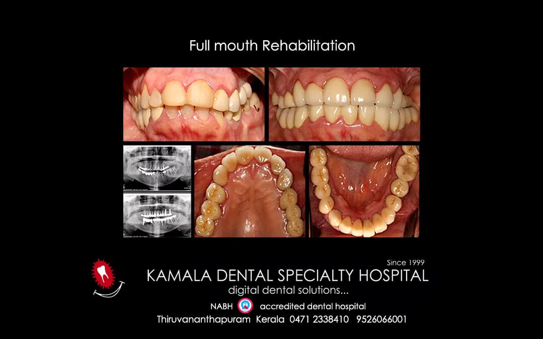 Full Mouth Rehabilitation