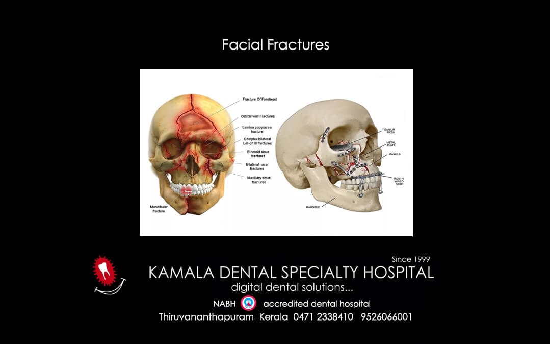 Facial Fractures