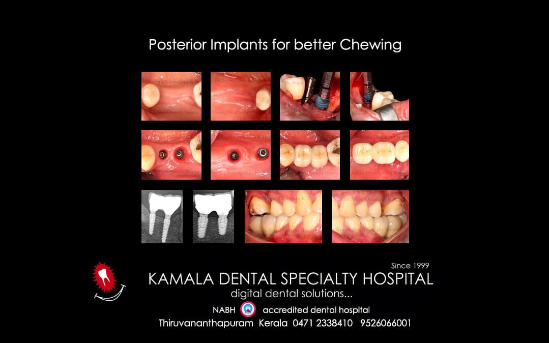 Posterior Implants for better Chewing.