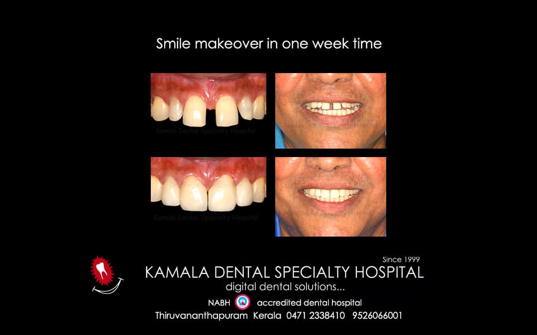 A Confident Younger Smile in a week time !!!
