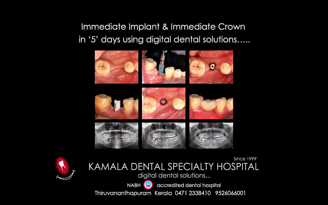 Immediate Implant & Immediate Crown in ‘5’ days using digital dental solutions…..