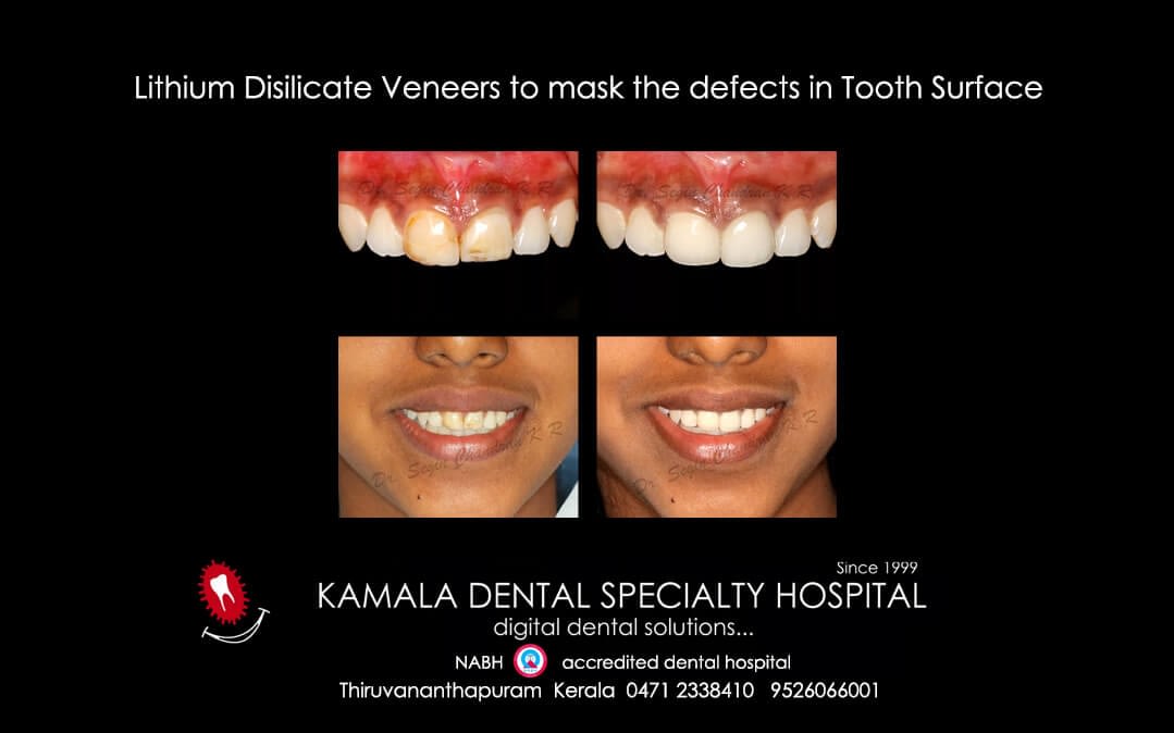 Lithium Disilicate Veneers to mask the defects in tooth surface