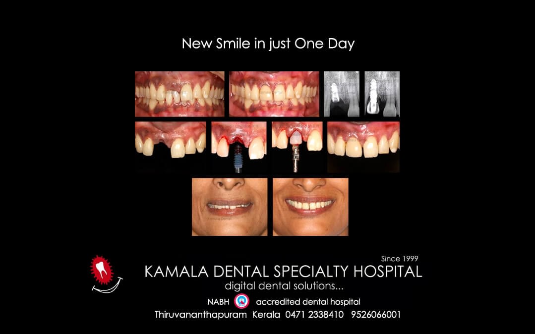 New smile in one day!…..