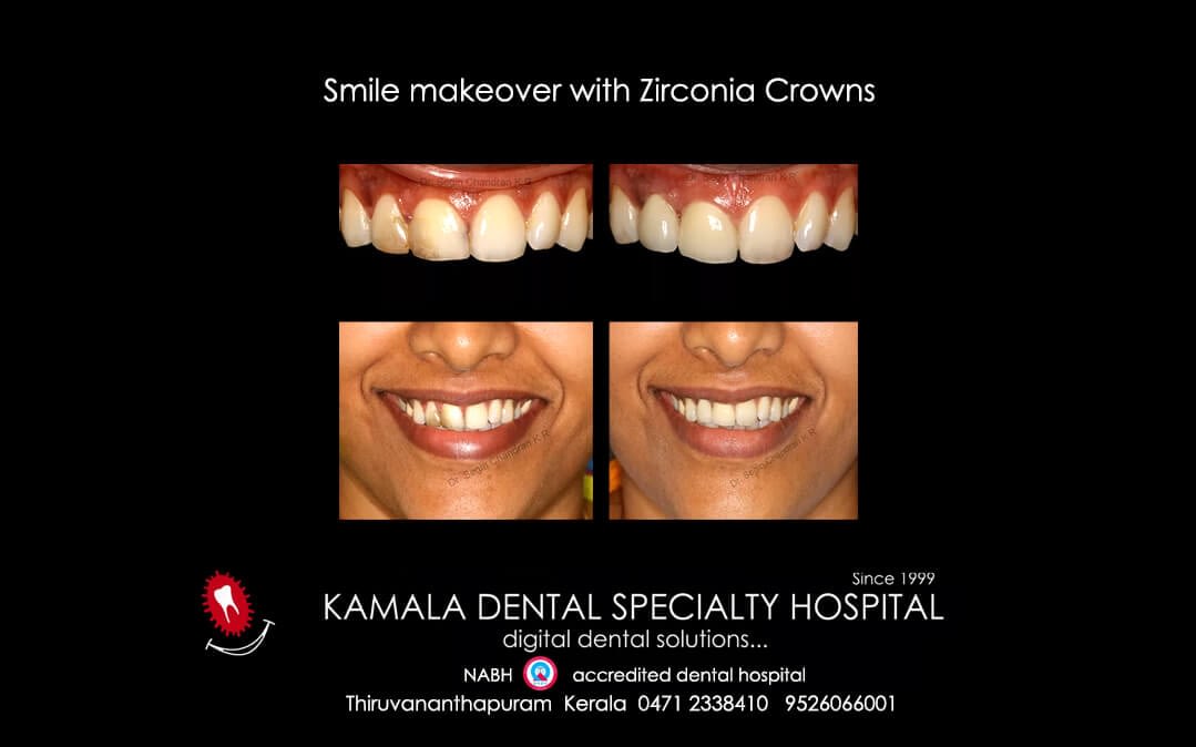 Smile Makeover with Zirconia crowns