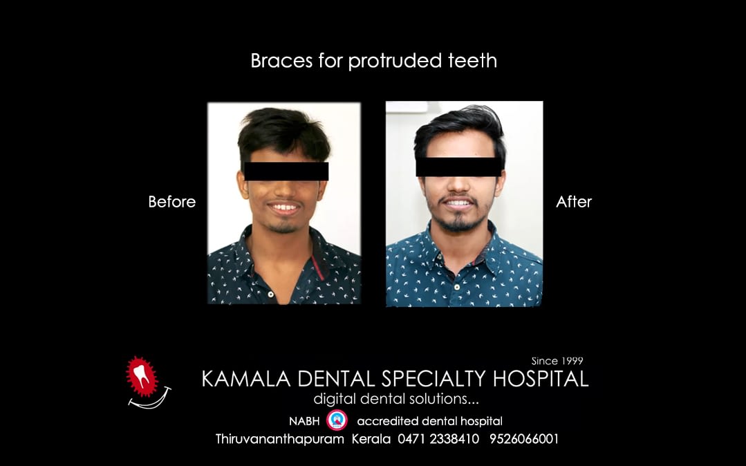 “Smile Correction” – “Space Closure” in Trivandrum